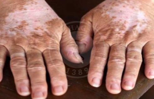 فواید قارچ بر بیماری پیسی