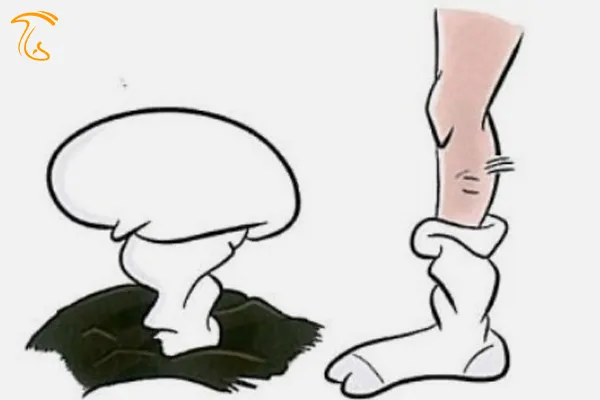 گود افتادگی ساقه (جوراب شل)