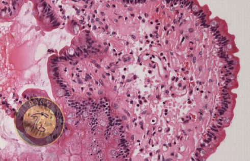 amyloid